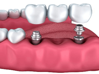 Dental Implant