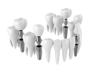 All-On-4 Dental Implants