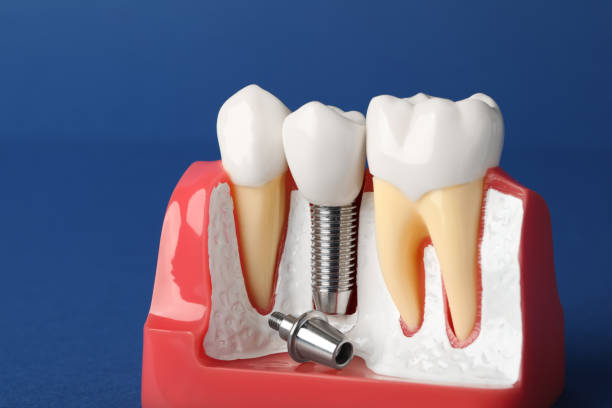 Dental Implants