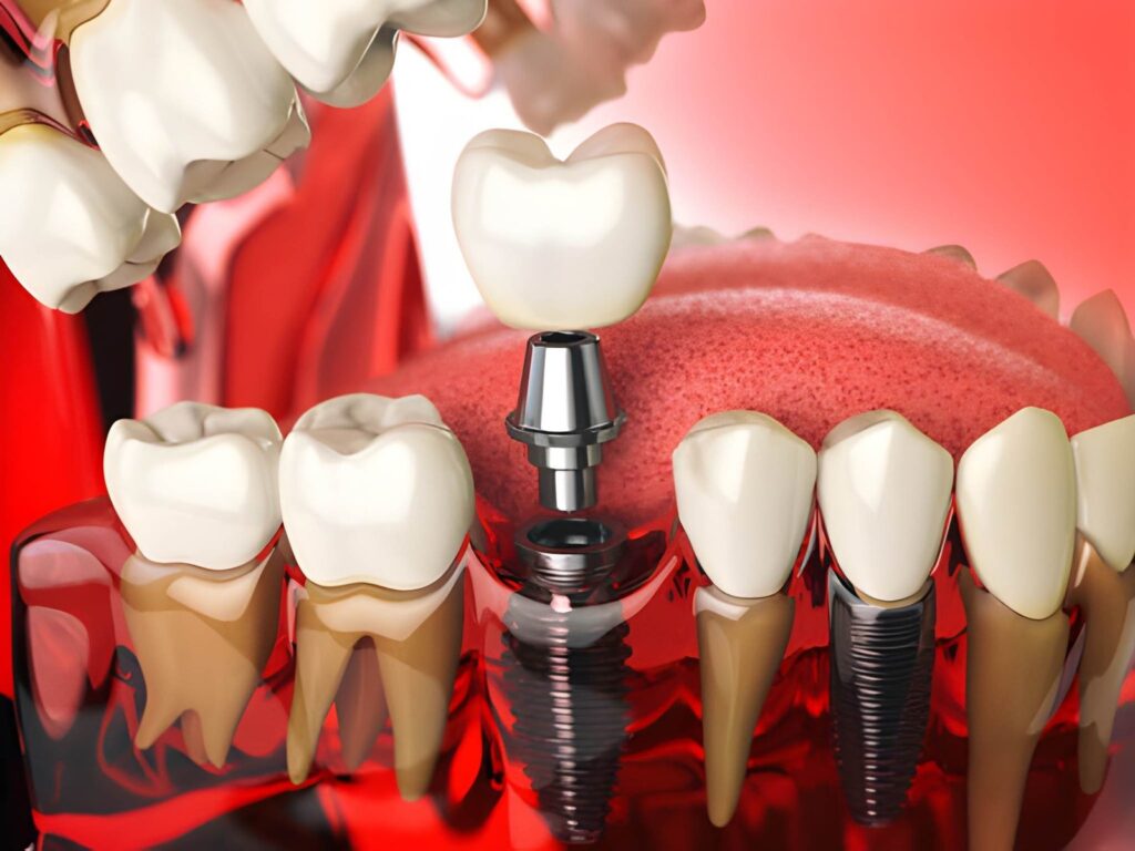Dental Implants Aberdeen