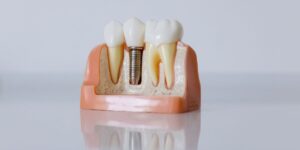 dental implant