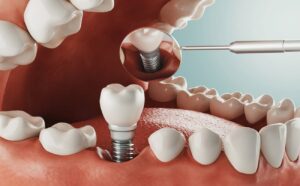 Dental Implants in Aberdeen