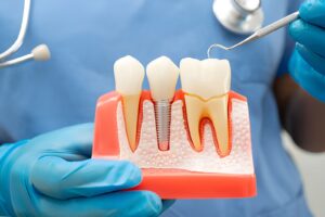 Dental Implant in Aberdeen